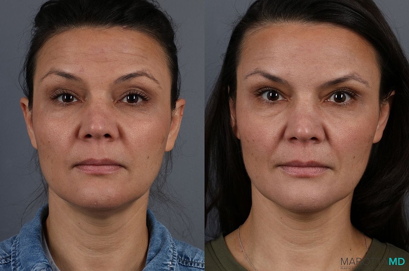 Botox Before & After