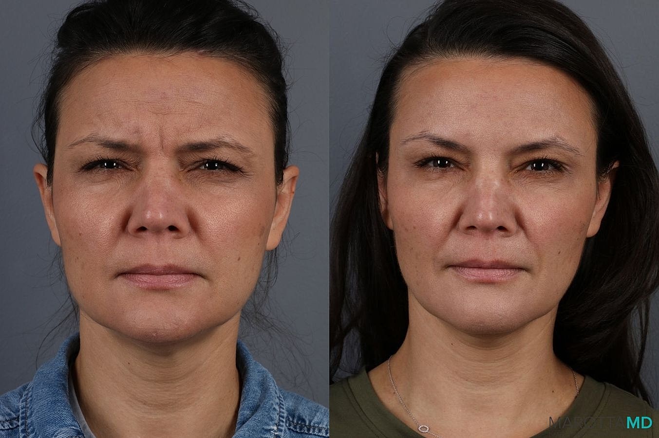 Botox Before & After