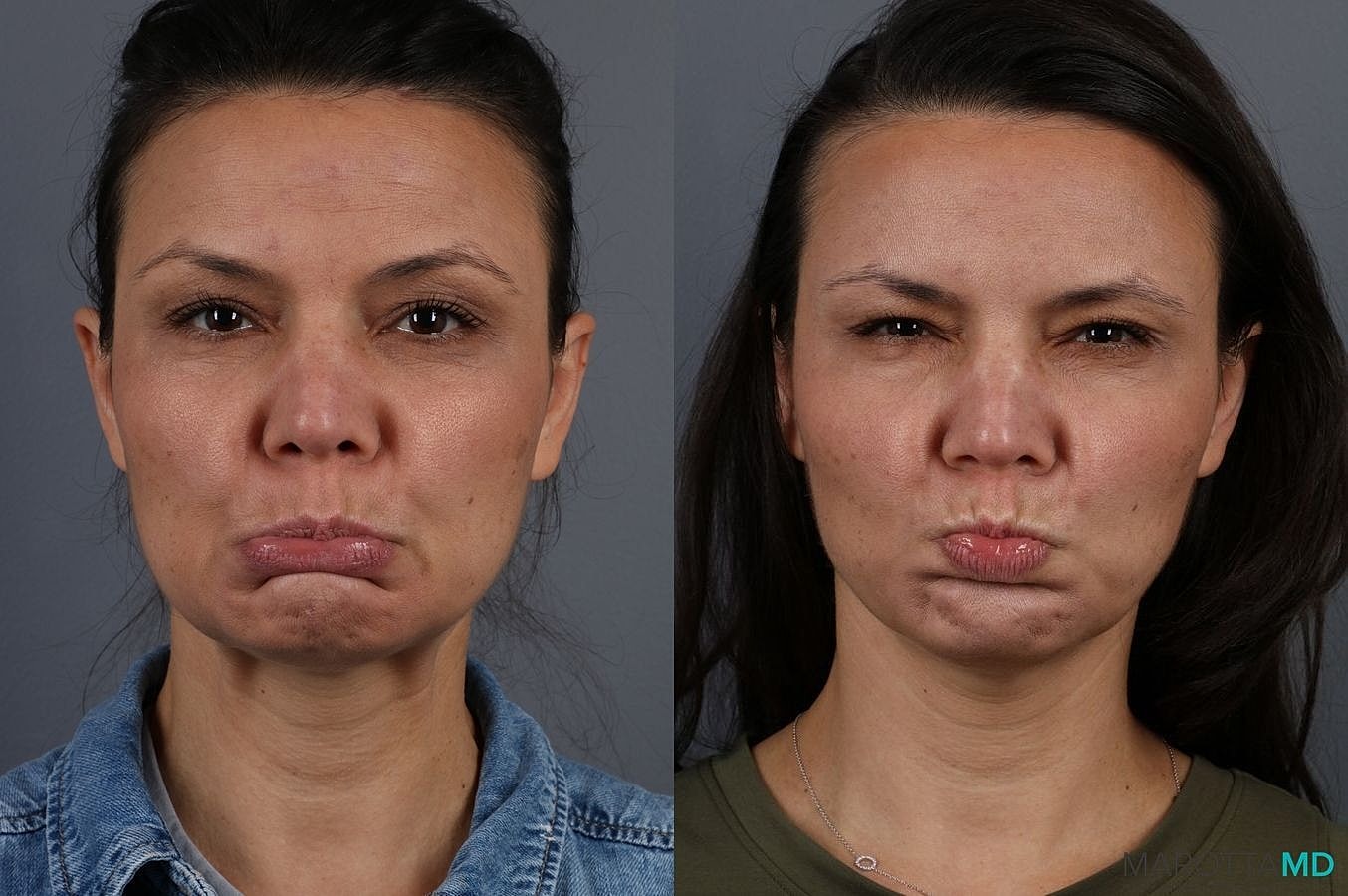 Botox Before & After