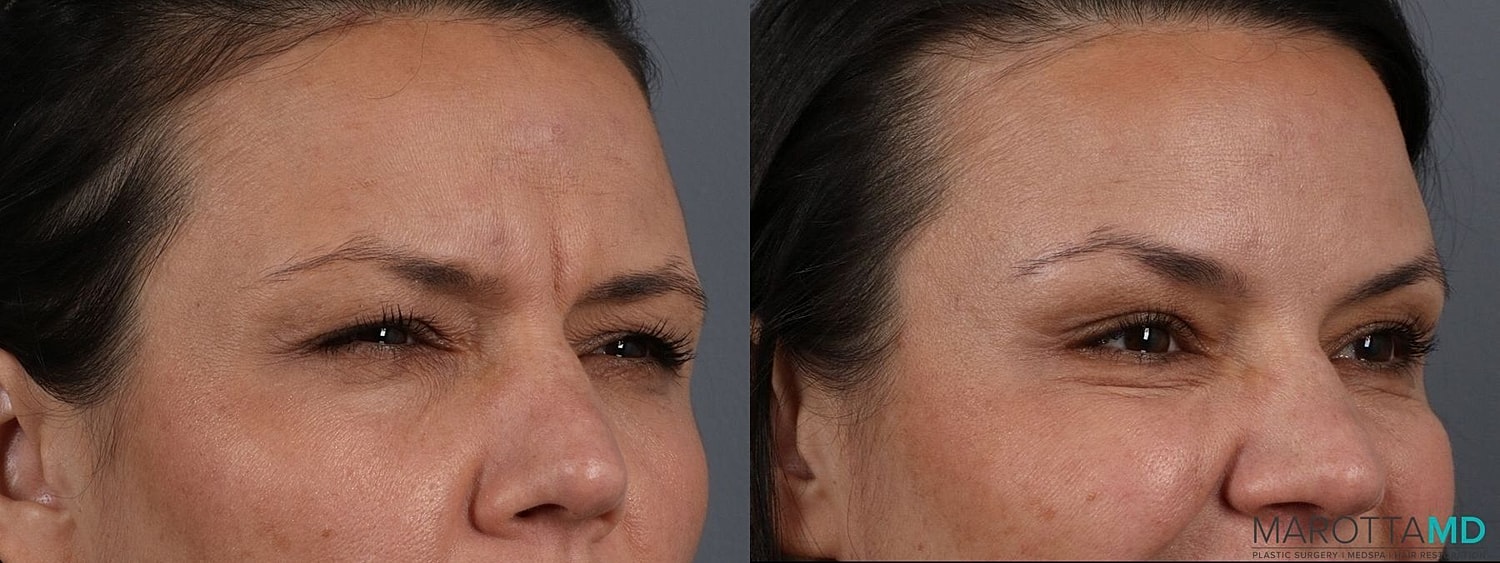 Botox Before & After