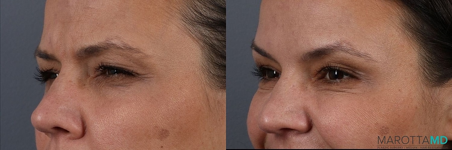 Botox Before & After