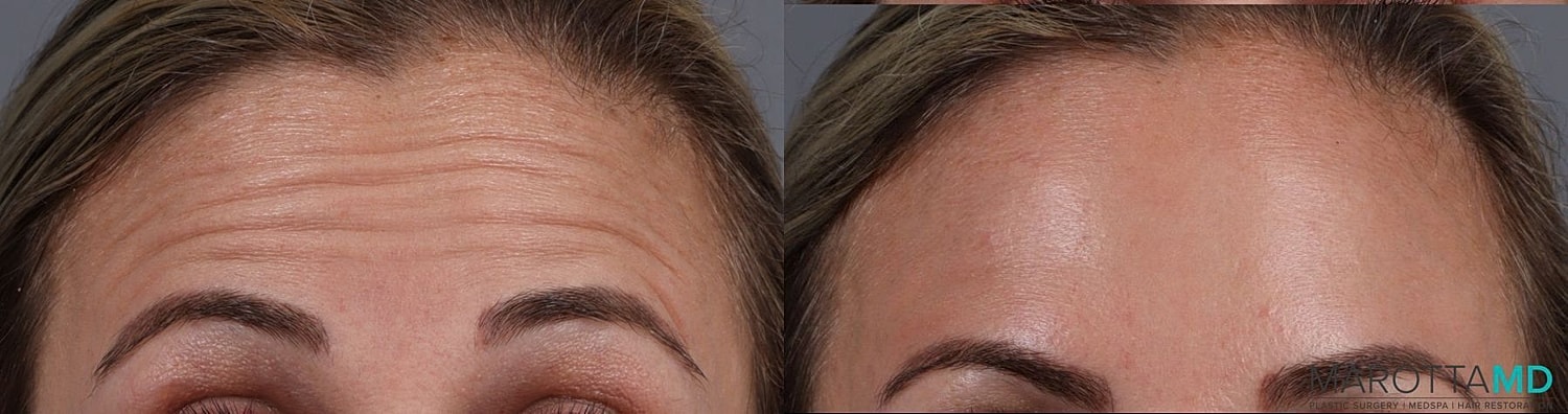 Botox Before & After