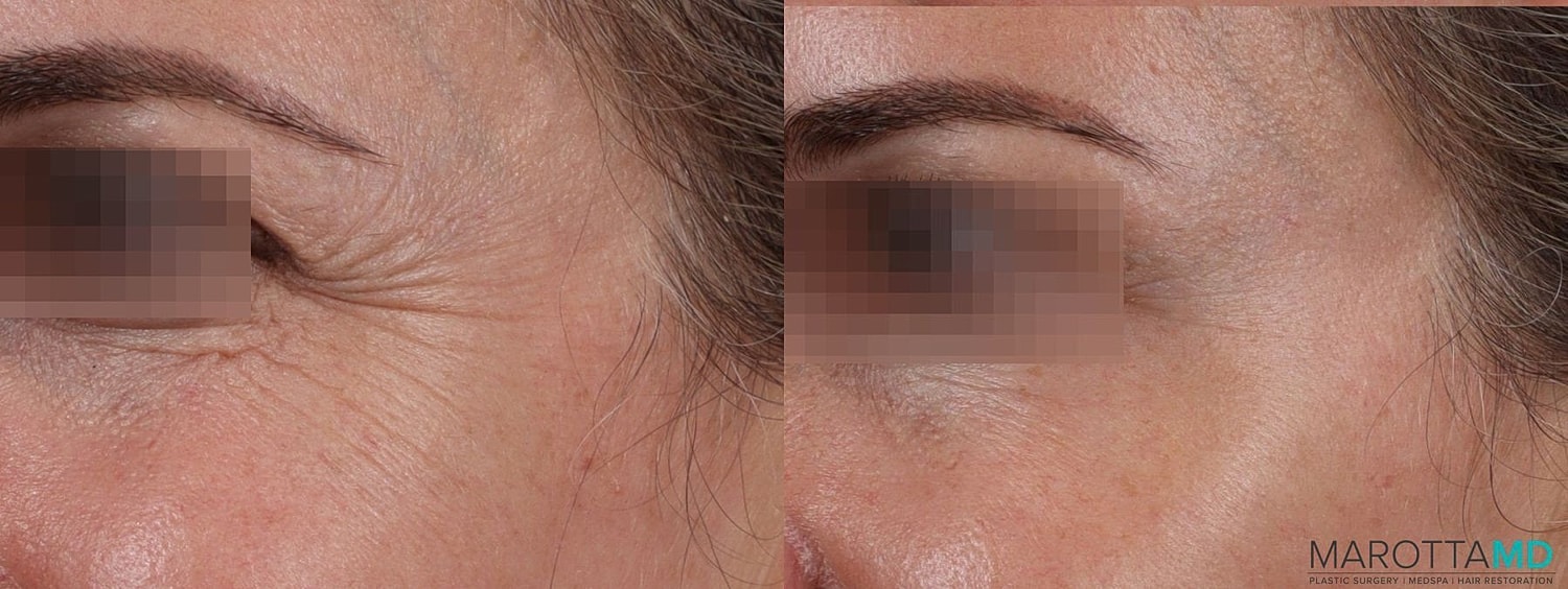 Botox Before & After