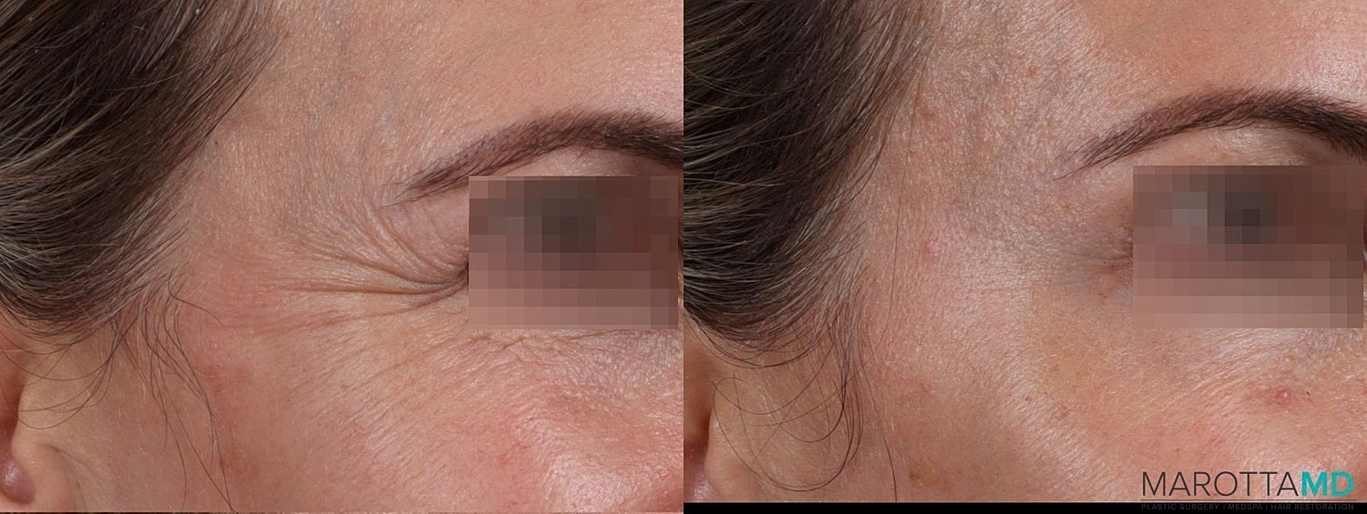 Botox Before & After