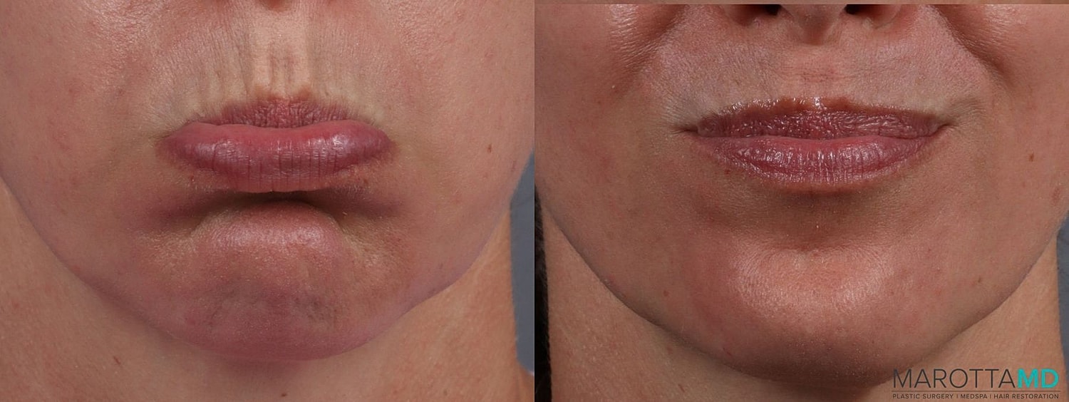 Botox Before & After