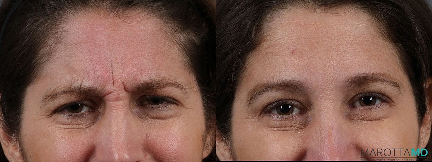 Botox Before & After