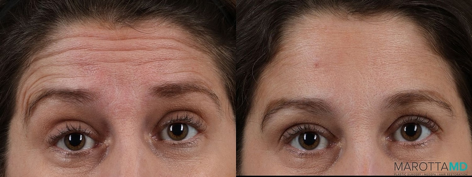 Botox Before & After