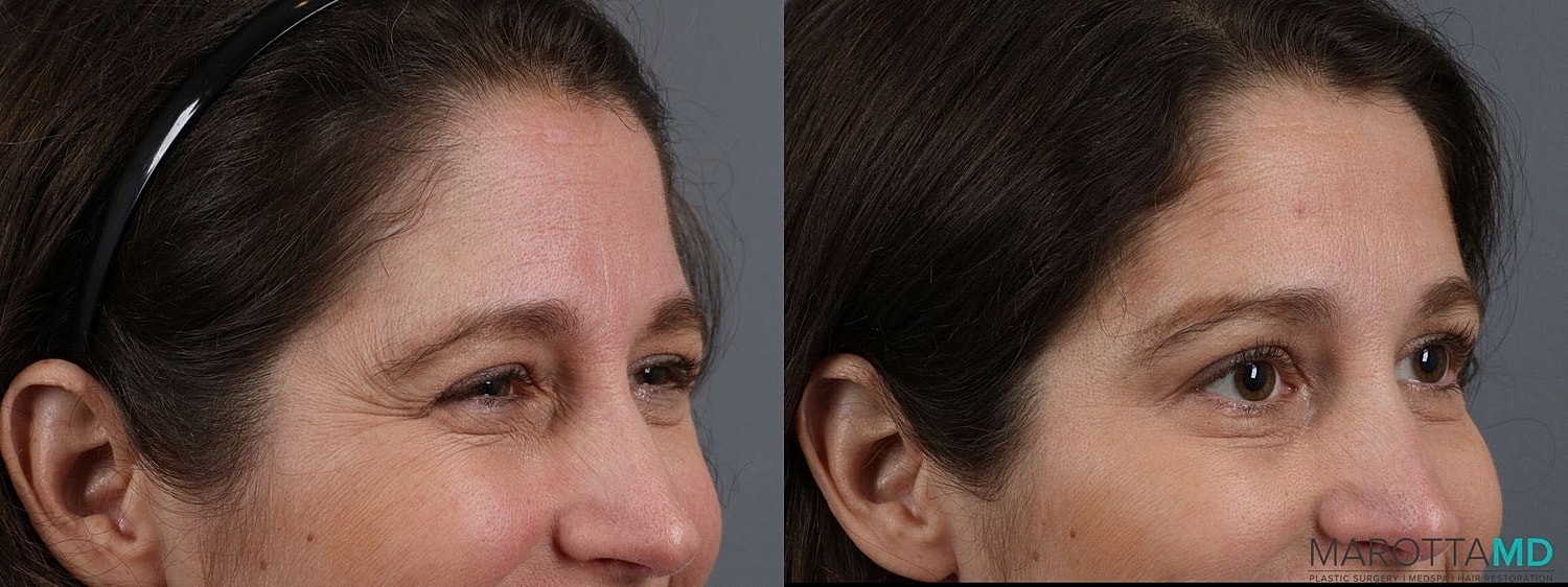 Botox Before & After