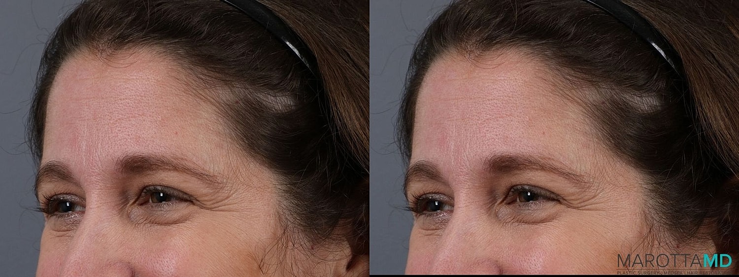 Botox Before & After