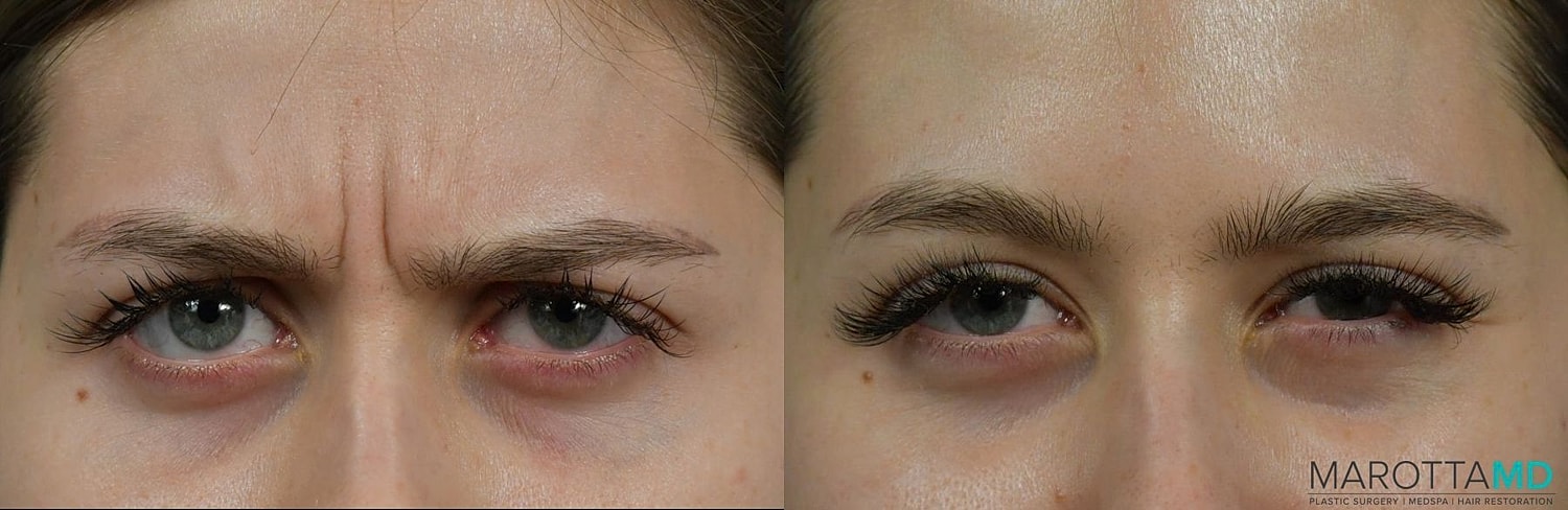 Botox Before & After
