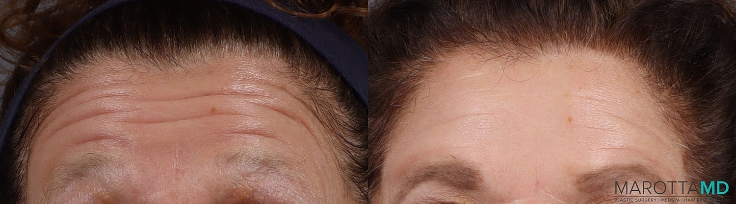 Botox Before & After