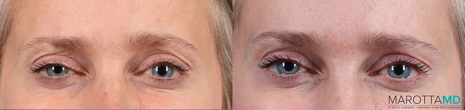 Botox Before & After
