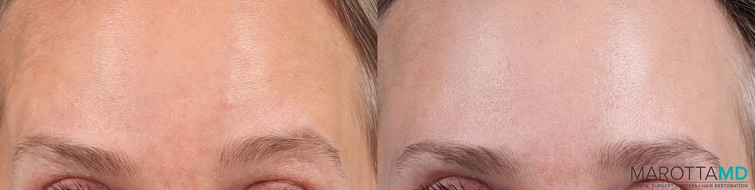 Botox Before & After