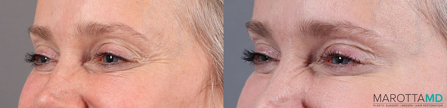 Botox Before & After