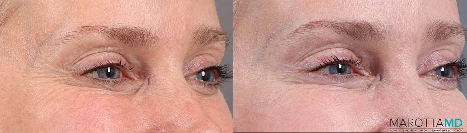 Botox Before & After