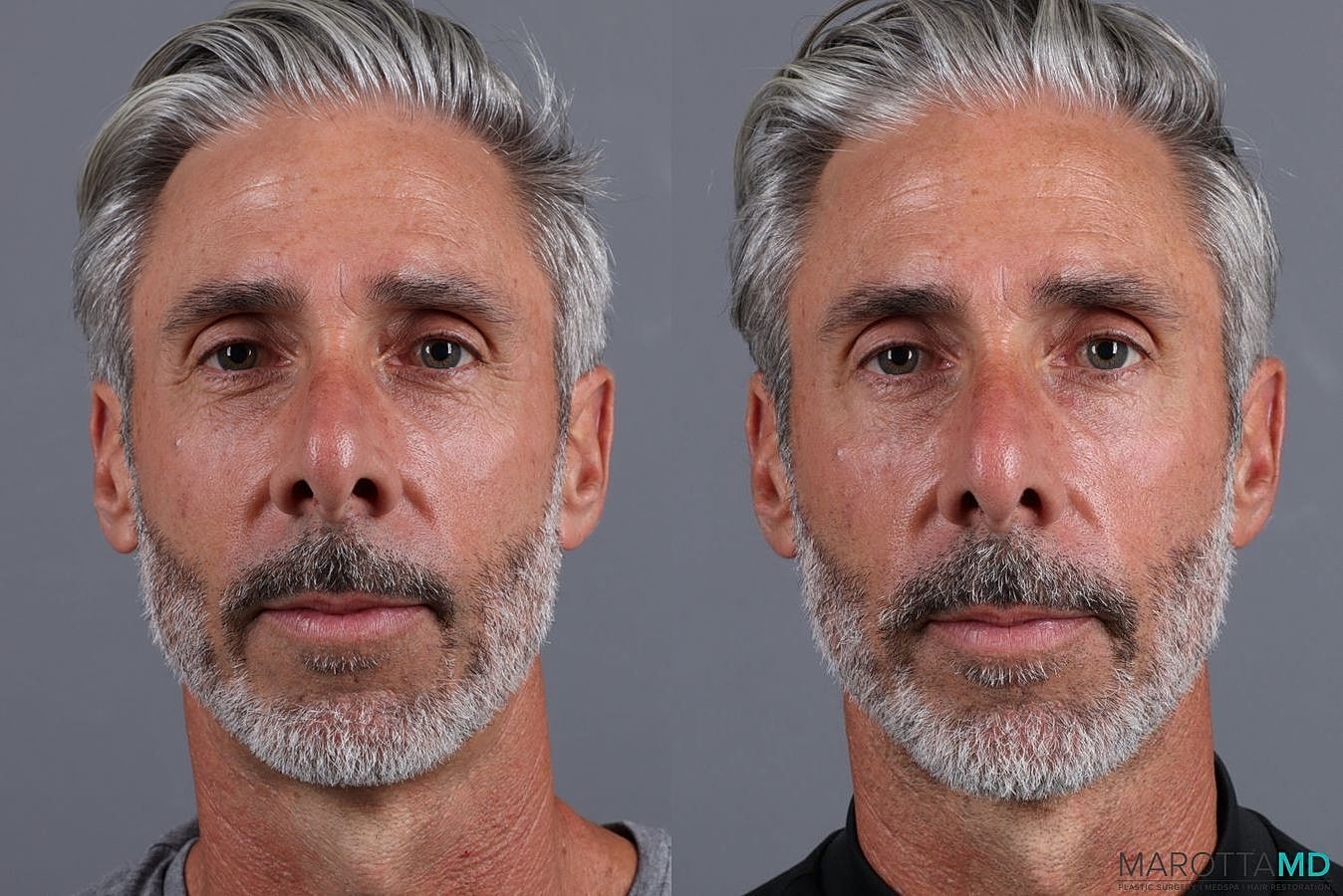 Botox Before & After