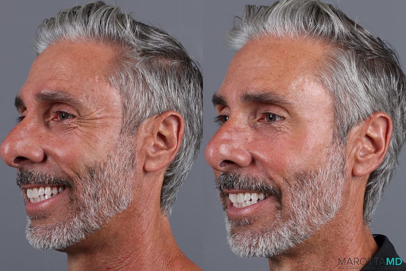 Botox Before & After