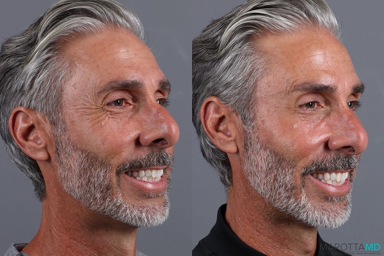 Botox Before & After