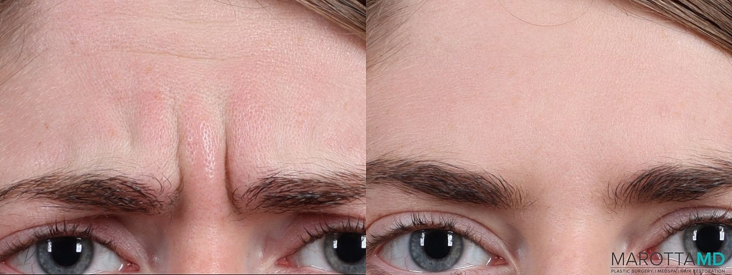 Botox Before & After