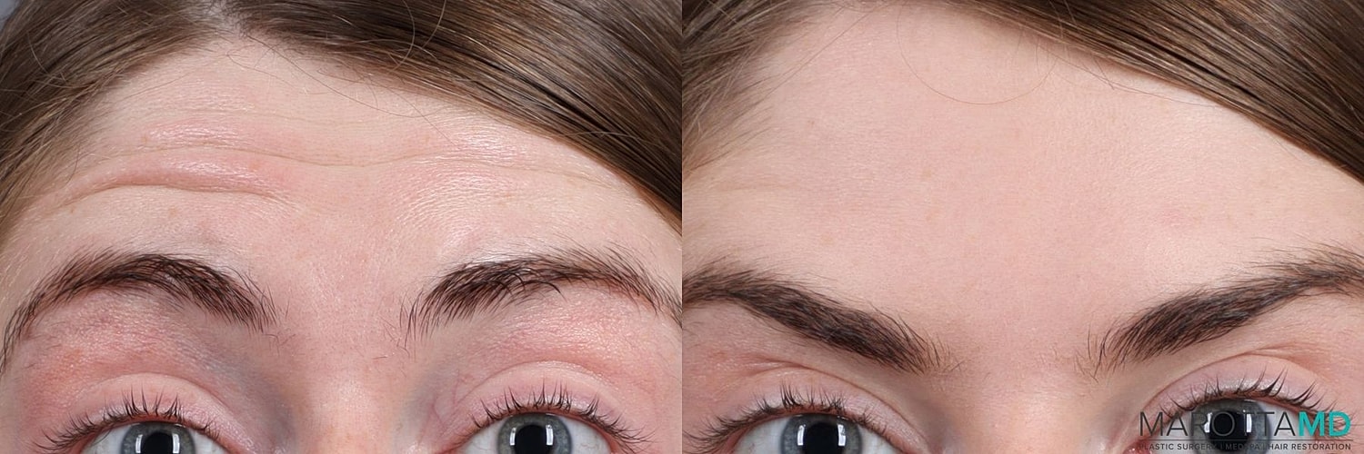 Botox Before & After