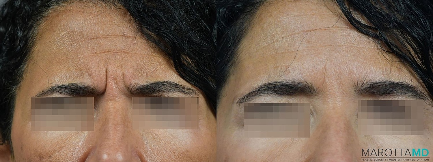 Botox Before & After