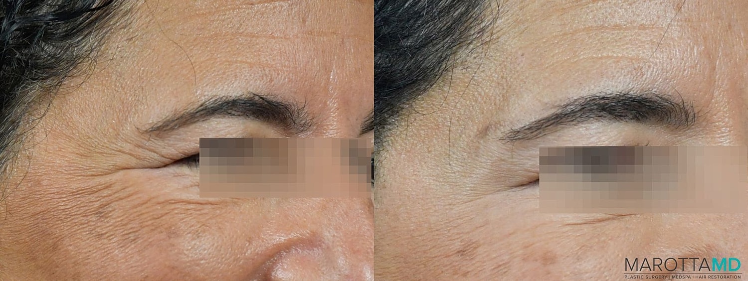 Botox Before & After