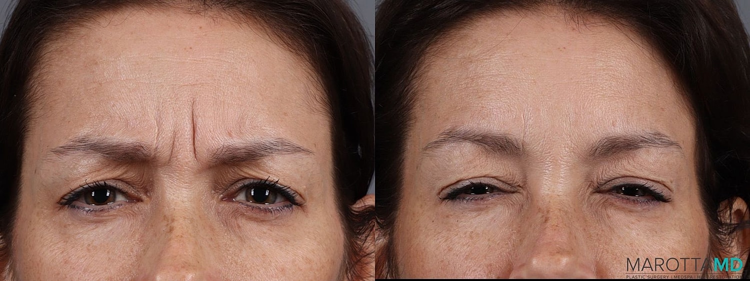 Botox Before & After