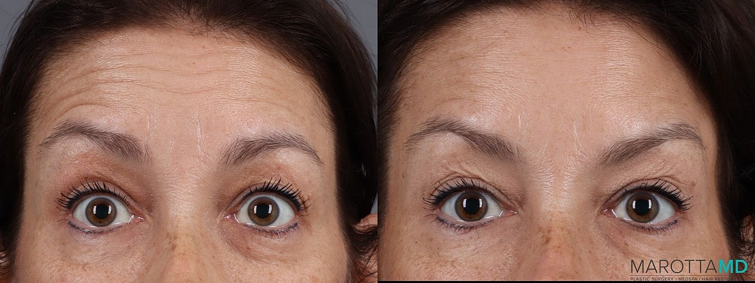 Botox Before & After