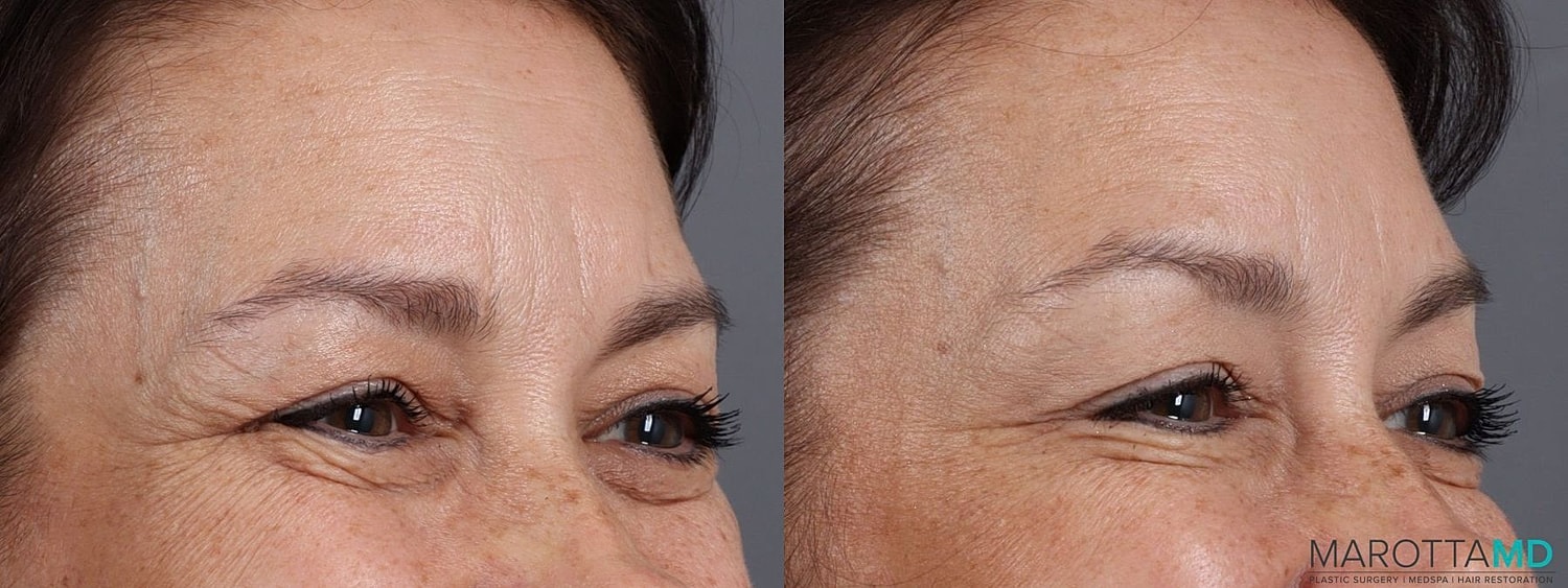 Botox Before & After