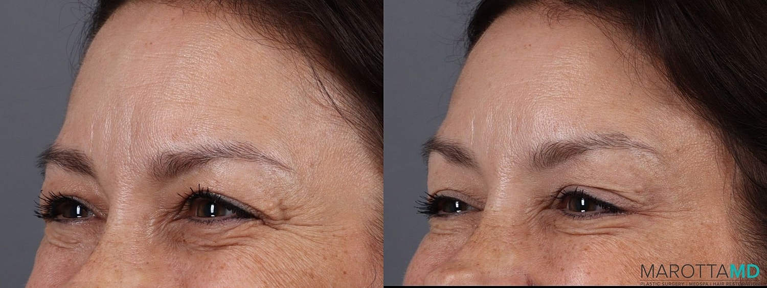 Botox Before & After