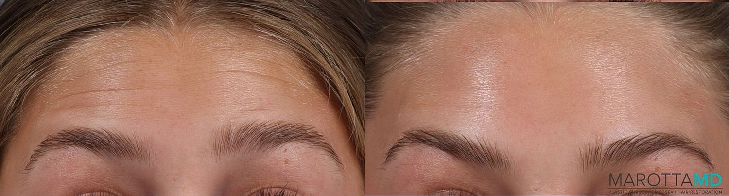 Botox Before & After