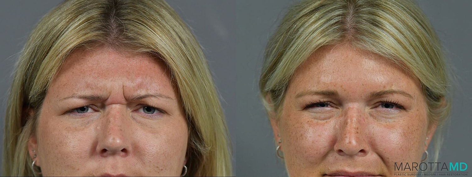 Botox Before & After