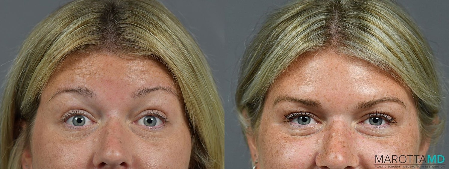 Botox Before & After