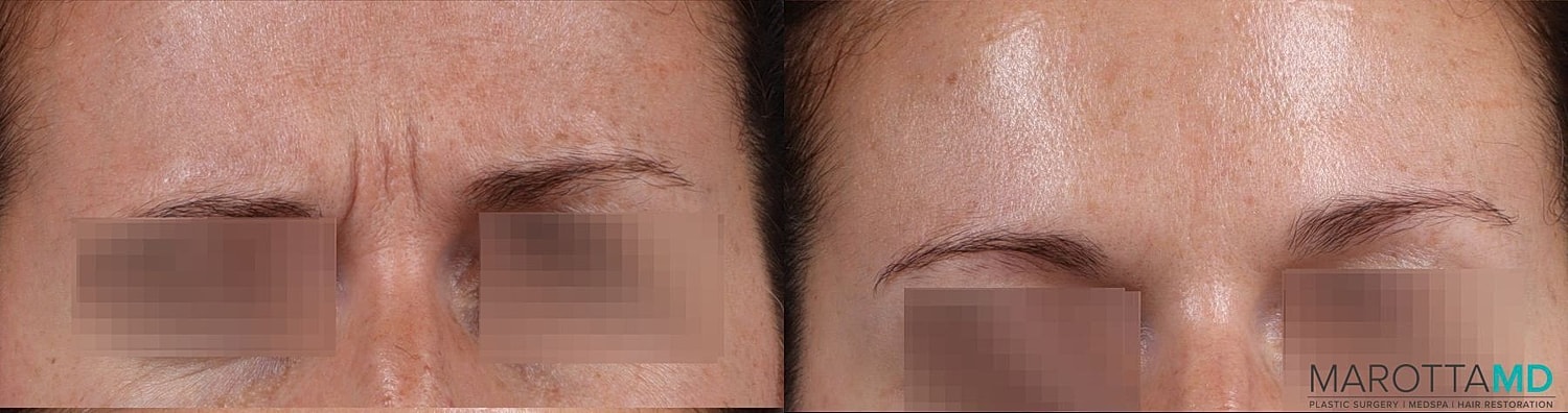 Botox Before & After
