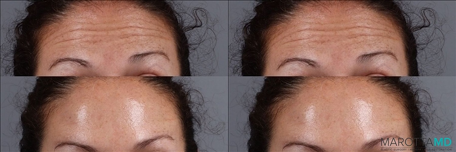 Botox Before & After