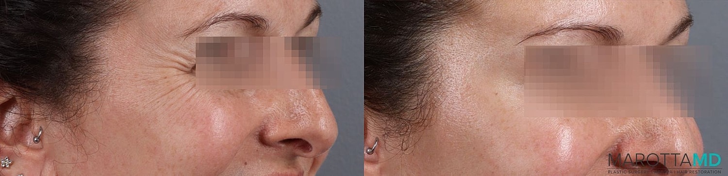 Botox Before & After