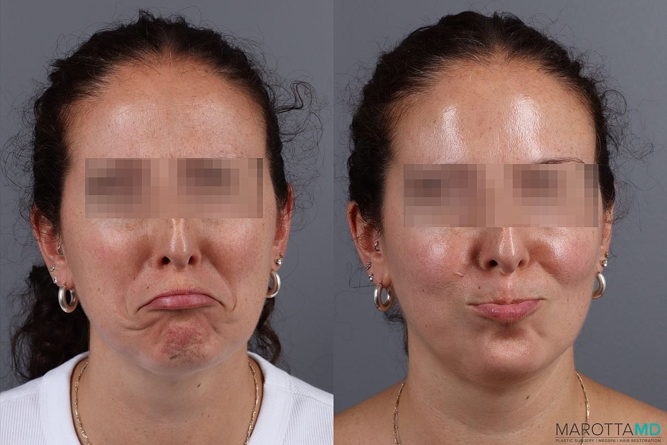 Botox Before & After