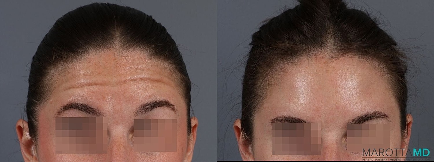 Botox Before & After