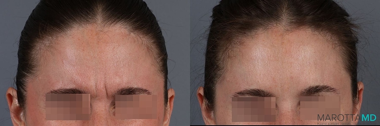 Botox Before & After