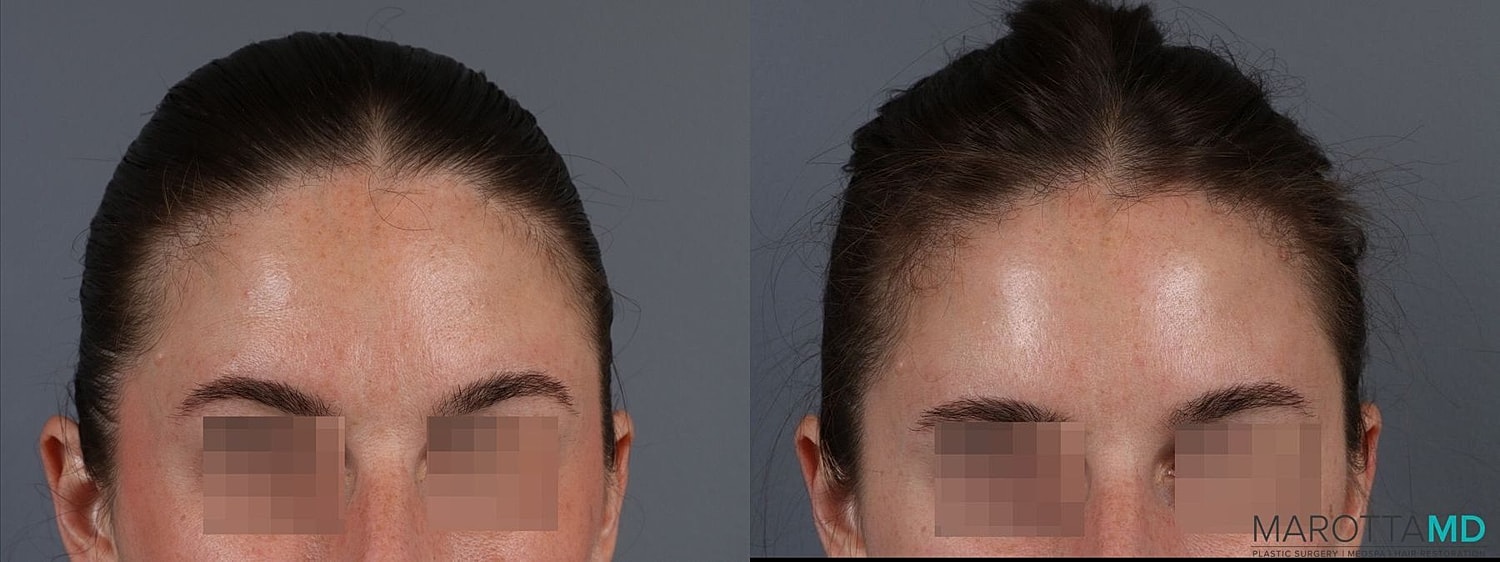 Botox Before & After