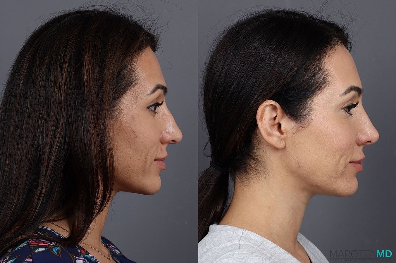 Botox Before & After