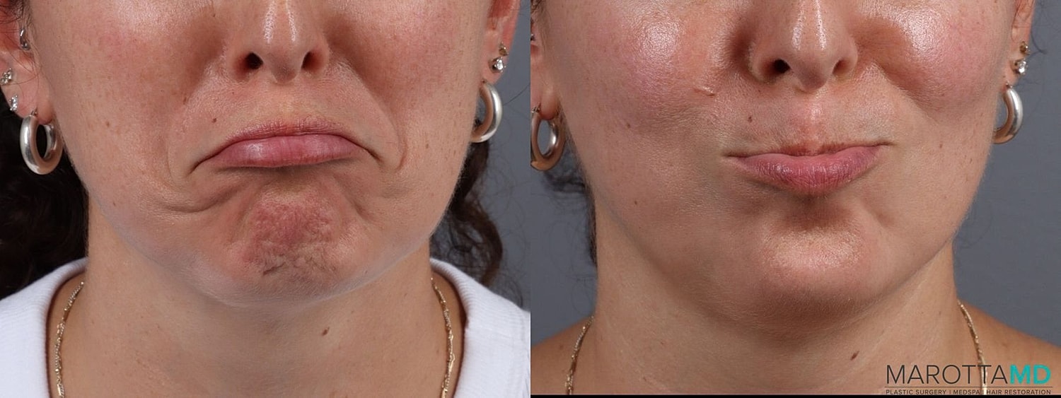 Botox Before & After