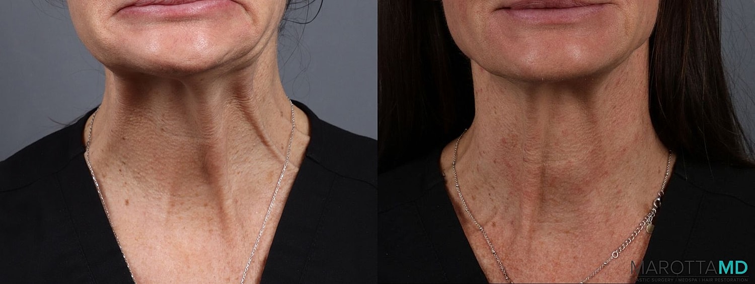 Botox Before & After