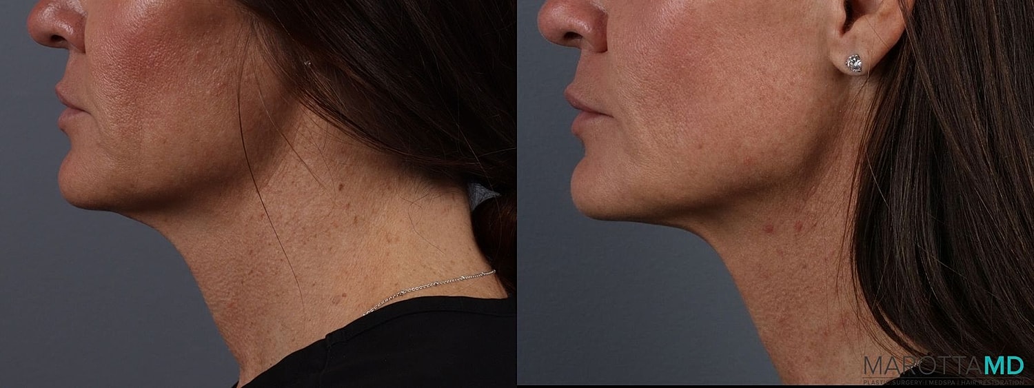 Botox Before & After