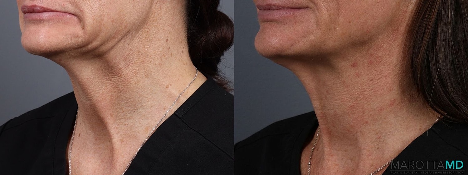 Botox Before & After