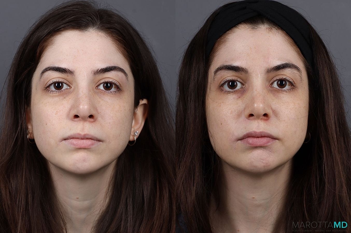 Botox Before & After