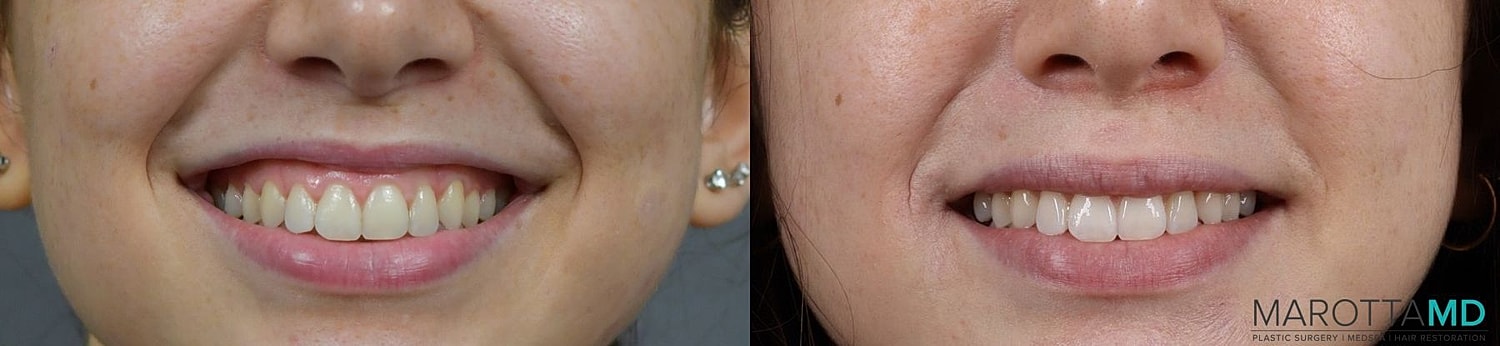 Botox Before & After