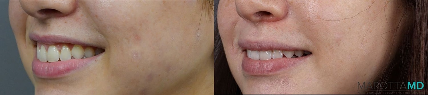 Botox Before & After