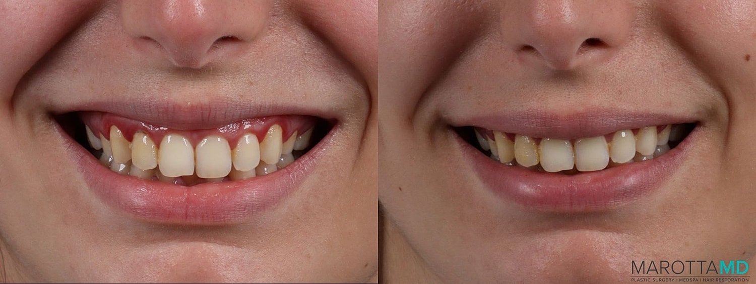Botox Before & After