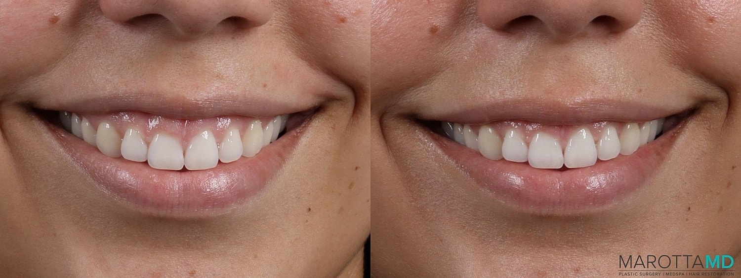Botox Before & After